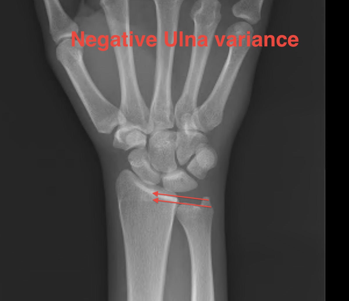 Ulna Variance Negative